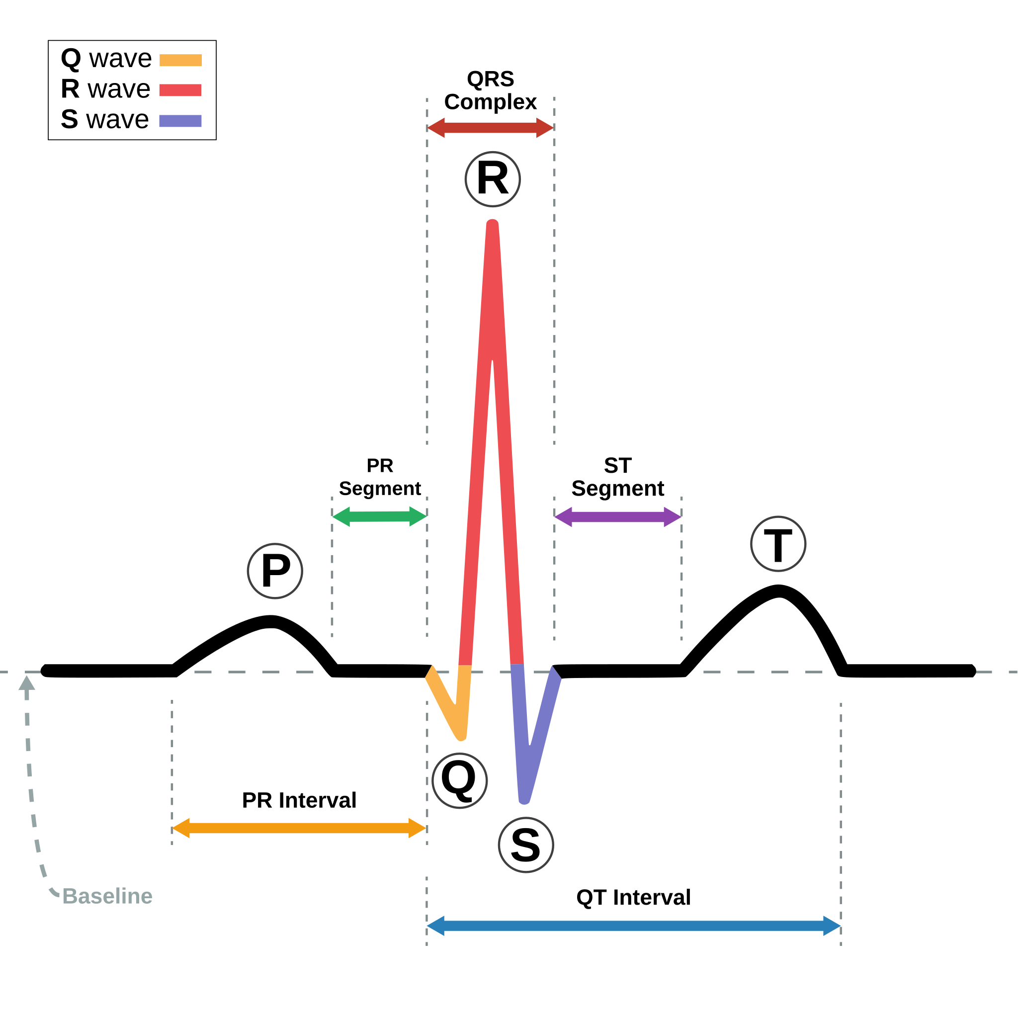 A diagram of a typical sinus rhythm on an EKG with labeled components including the P wave, QRS complex, T wave, PR interval, QT interval, and ST segment. The diagram shows the time intervals and amplitudes associated with each wave or segment.